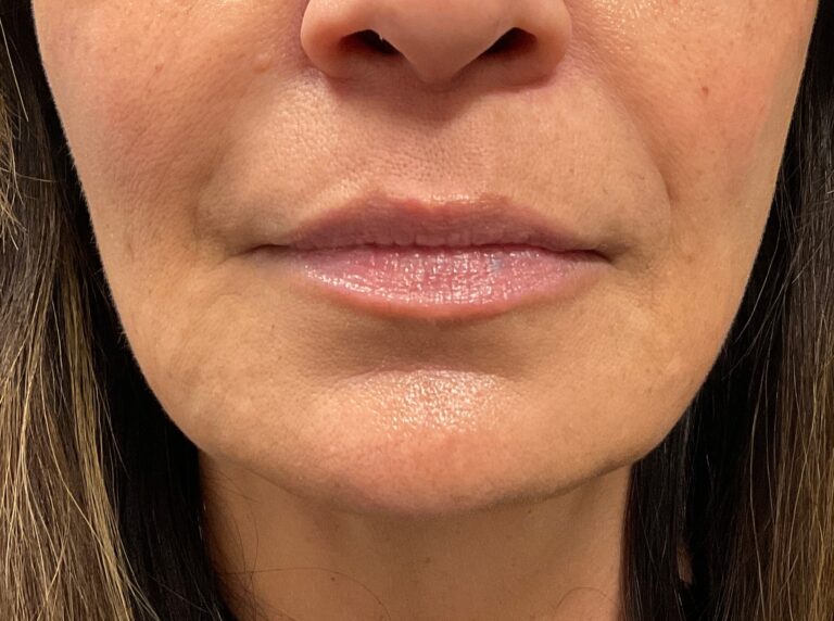After Image: Dermal Filler – Volbella (lips) - front