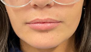 Before Image: Dermal Filler – Juvederm Ultra (lips)