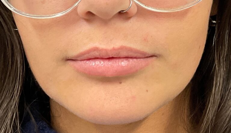 Before Image: Dermal Filler – Juvederm Ultra (lips) - front