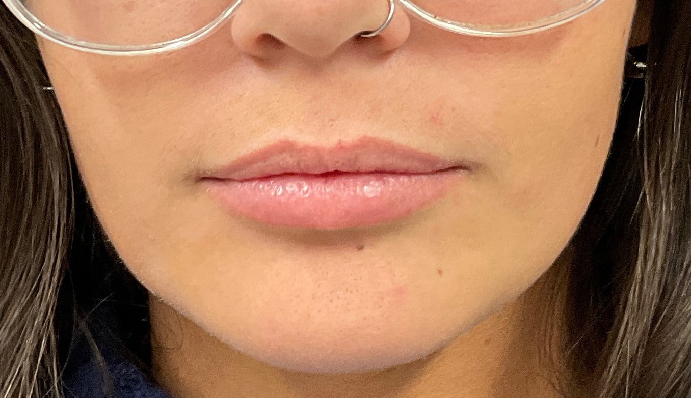 Dermal Fillers – Juvederm Ultra (lips)