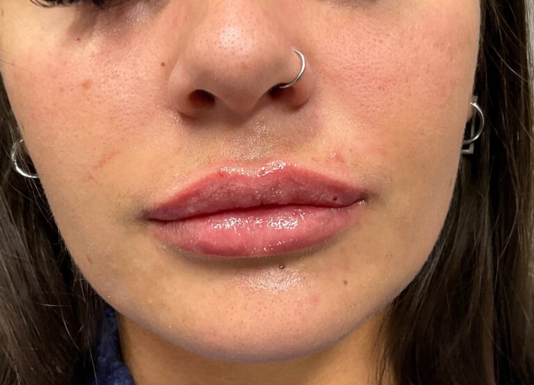 After Image: Dermal Filler – Juvederm Ultra (lips) - front