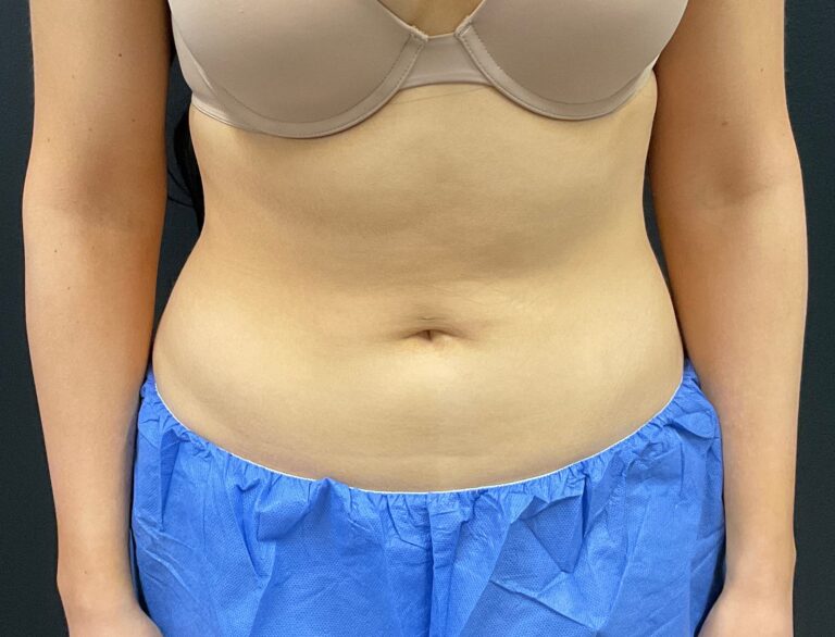 After Image: CoolSculpting – Abdomen - front