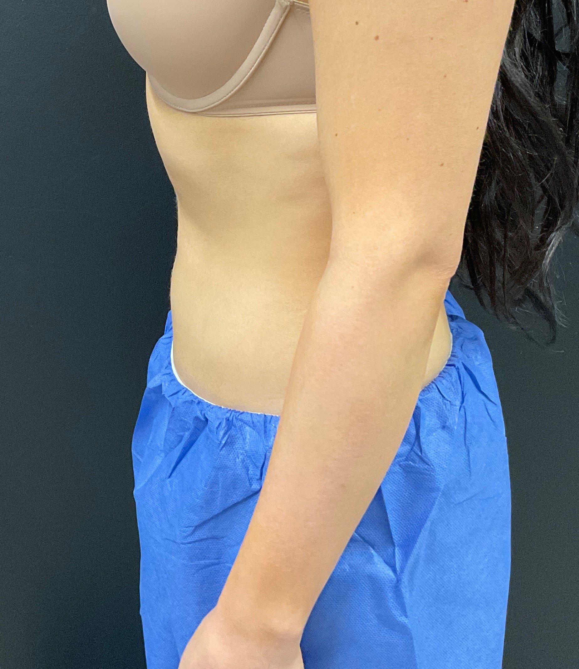 After Image: CoolSculpting – Abdomen - left-side