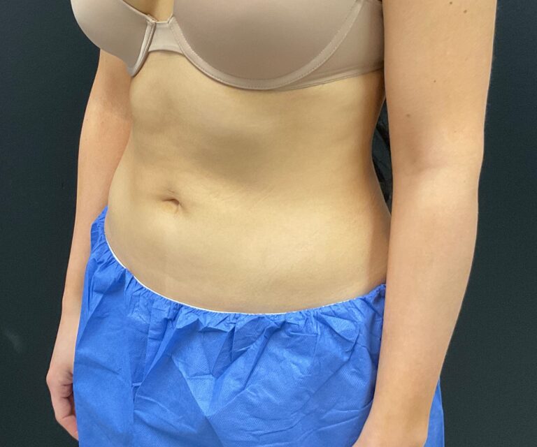 After Image: CoolSculpting – Abdomen - left-front-oblique