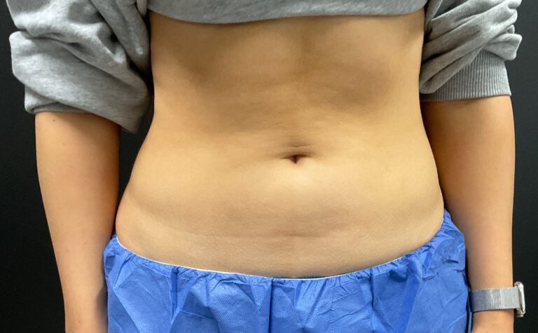 Before Image: CoolSculpting – Abdomen - front