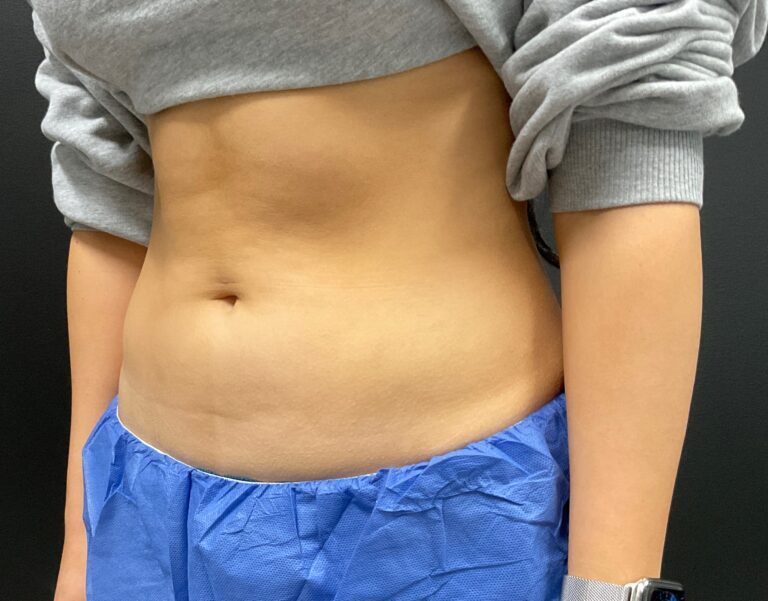 Before Image: CoolSculpting – Abdomen - left-front-oblique