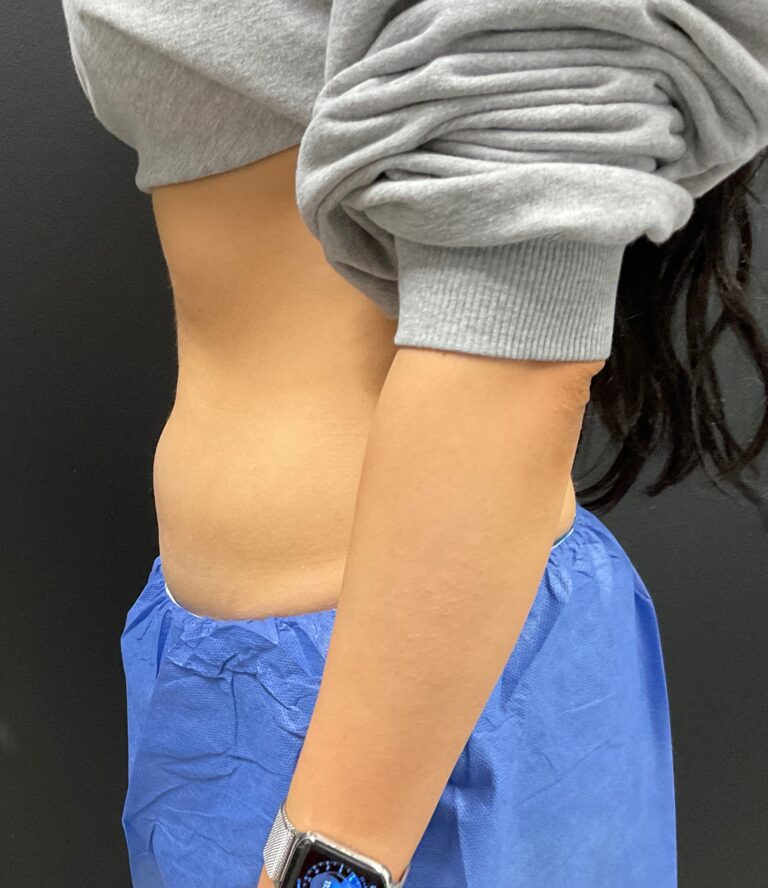 Before Image: CoolSculpting – Abdomen - left-side