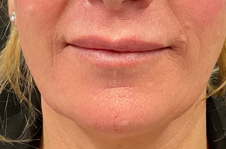 Before Image: Dermal Filler – Versa Lips (lips) - front