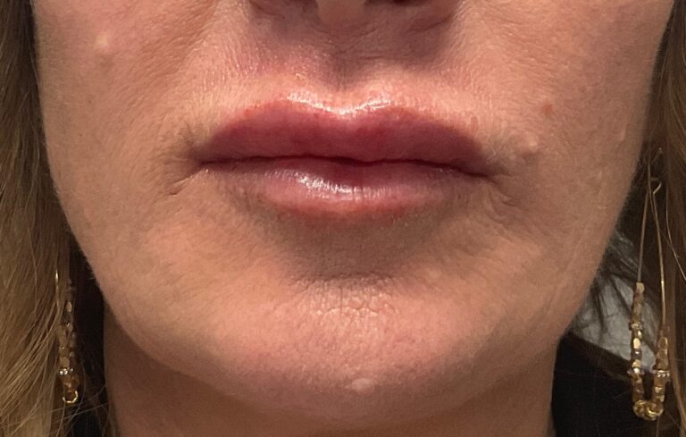 After Image: Dermal Filler – Versa Lips (lips) - front