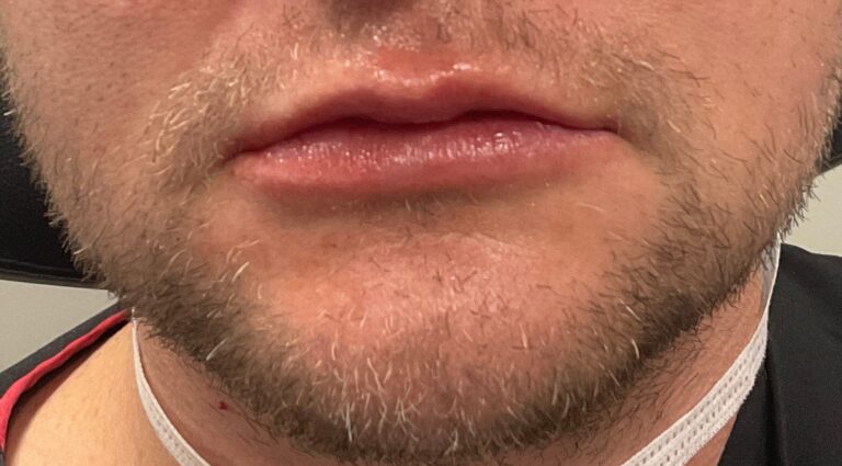 After Image: Lips – Volbella and Juvederm Ultra - front