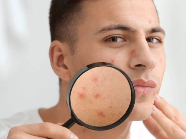 Portrait of young man with acne problem and magnifier at home