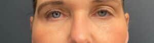 Before Image: Upneeq (For low-lying lids)