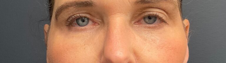 Before Image: Upneeq (For low-lying lids) - front