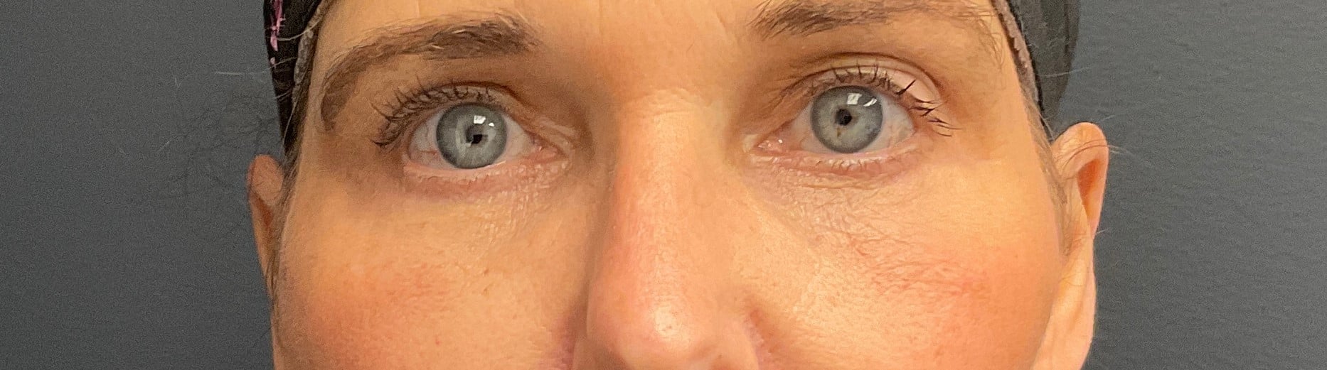 After Image: Upneeq (For low-lying lids) - front