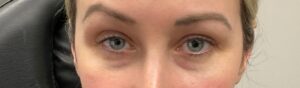 Before Image: Upneeq (For low-lying lids)