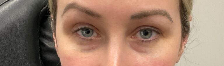 Before Image: Upneeq (For low-lying lids) - front