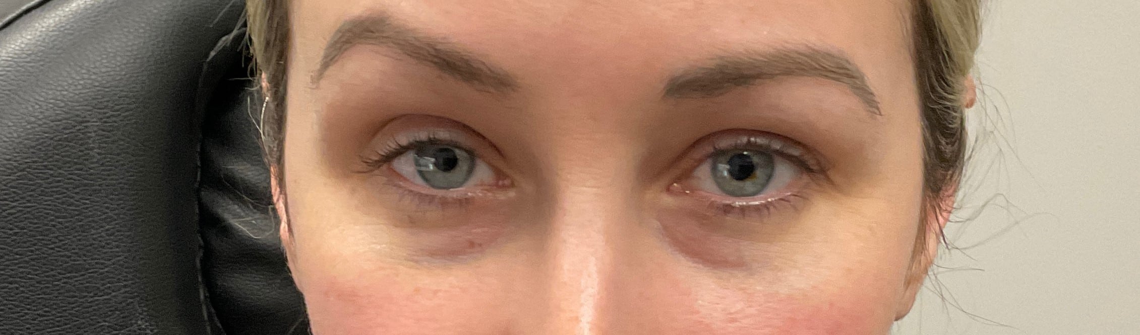 Before Image: Upneeq (For low-lying lids) - front