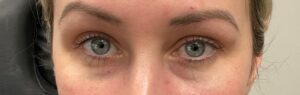 After Image: Upneeq (For low-lying lids)