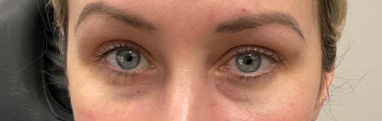 After Image: Upneeq (For low-lying lids) - front