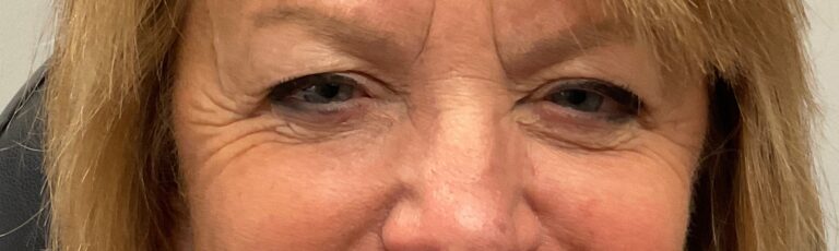 Before Image: Upneeq (For low-lying lids) - front