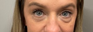 Before Image: Upneeq (For low-lying lids)