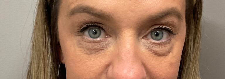Before Image: Upneeq (For low-lying lids) - front