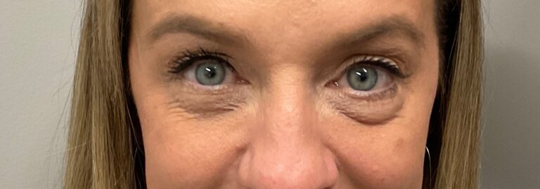 After Image: Upneeq (For low-lying lids) - front