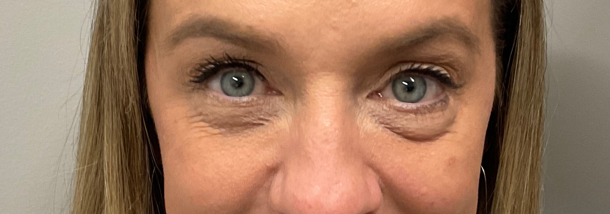 After Image: Upneeq (For low-lying lids) - front