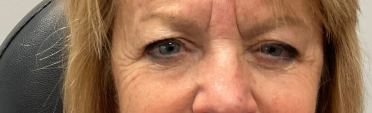 After Image: Upneeq (For low-lying lids) - front