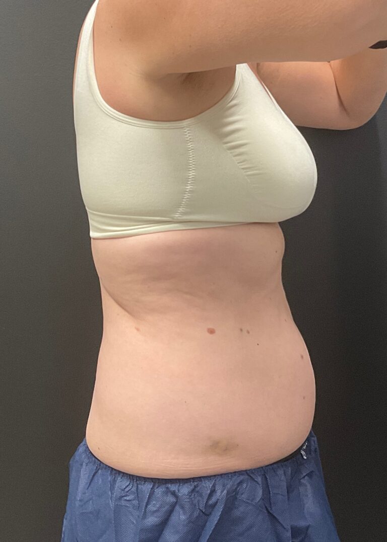 After Image: CoolSculpting – Abdomen and Flanks - right-side