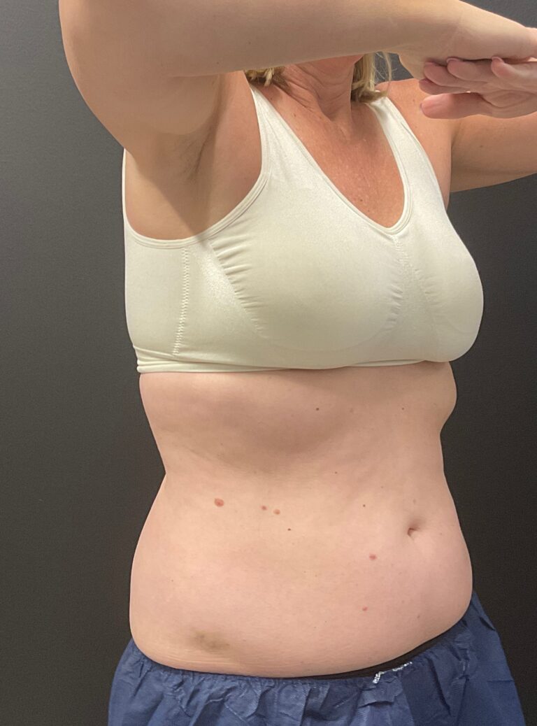 After Image: CoolSculpting – Abdomen and Flanks - right-front-oblique
