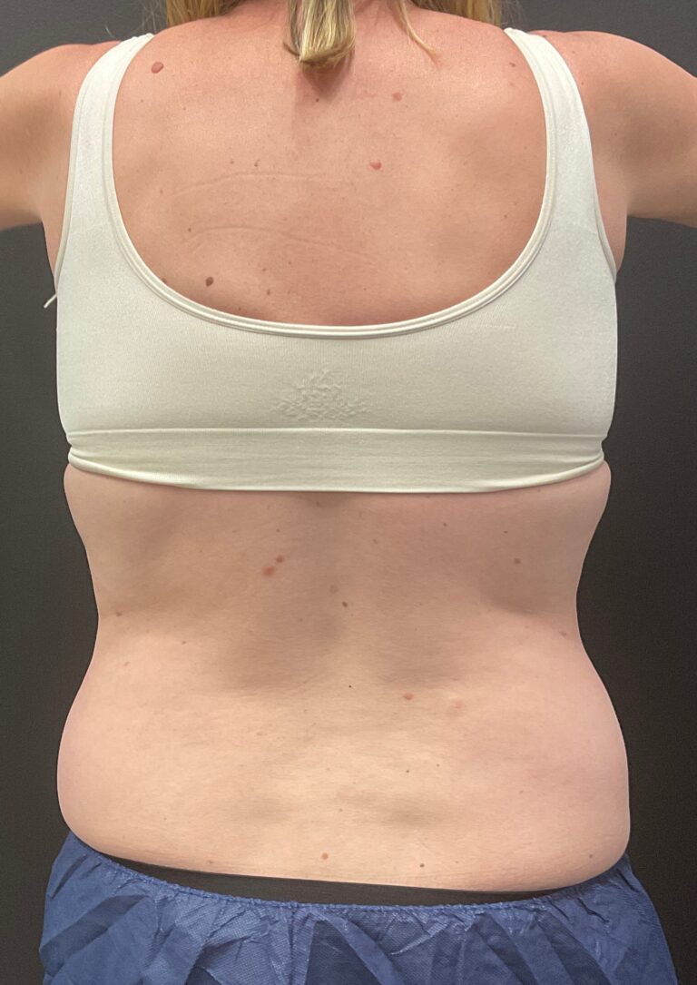 After Image: CoolSculpting – Abdomen and Flanks - back