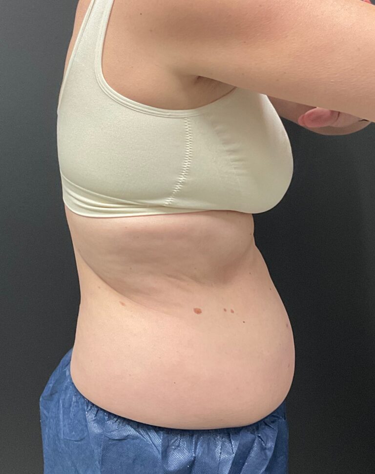Before Image: CoolSculpting – Abdomen and Flanks - right-side