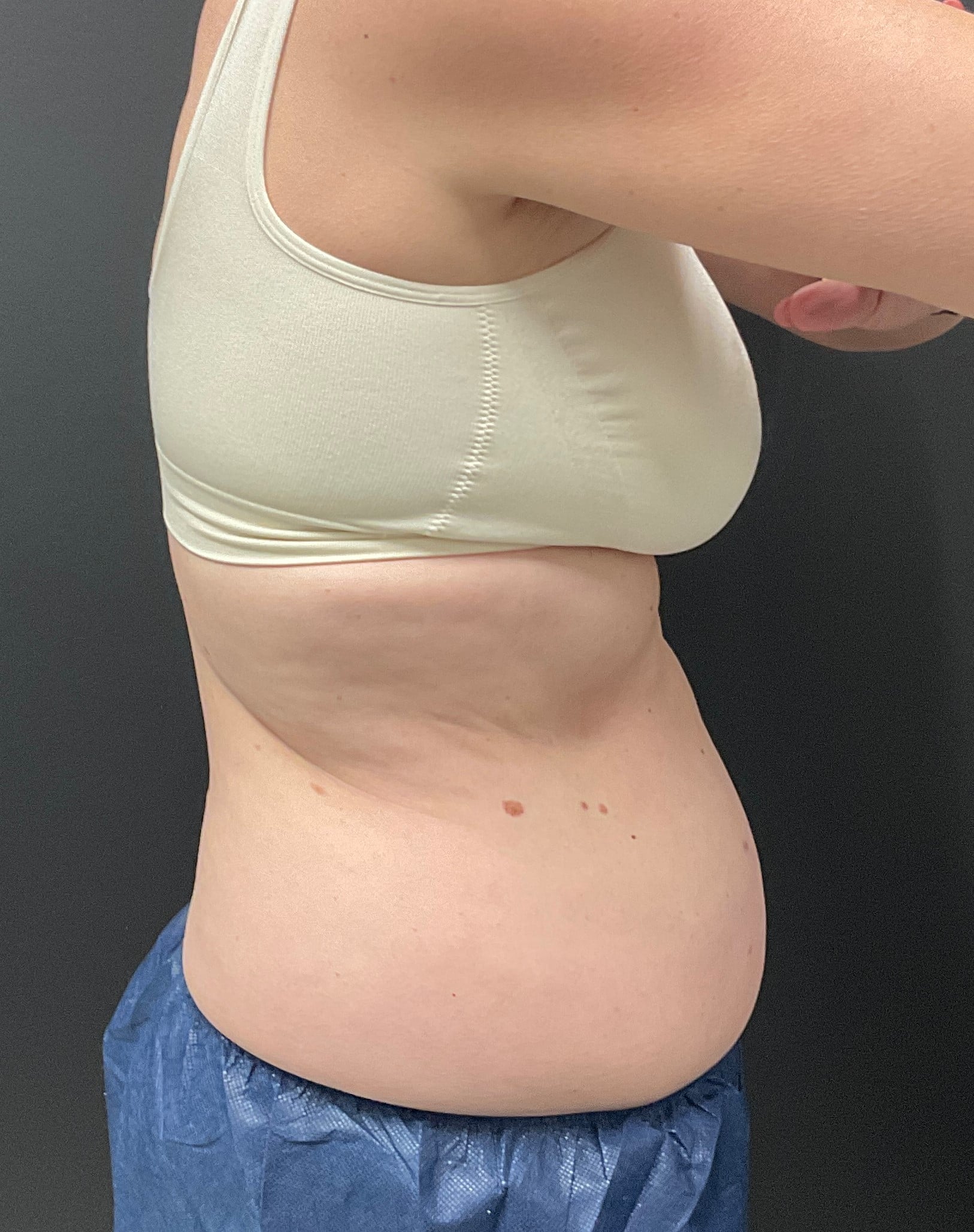 Before Image: CoolSculpting – Abdomen and Flanks - right-side