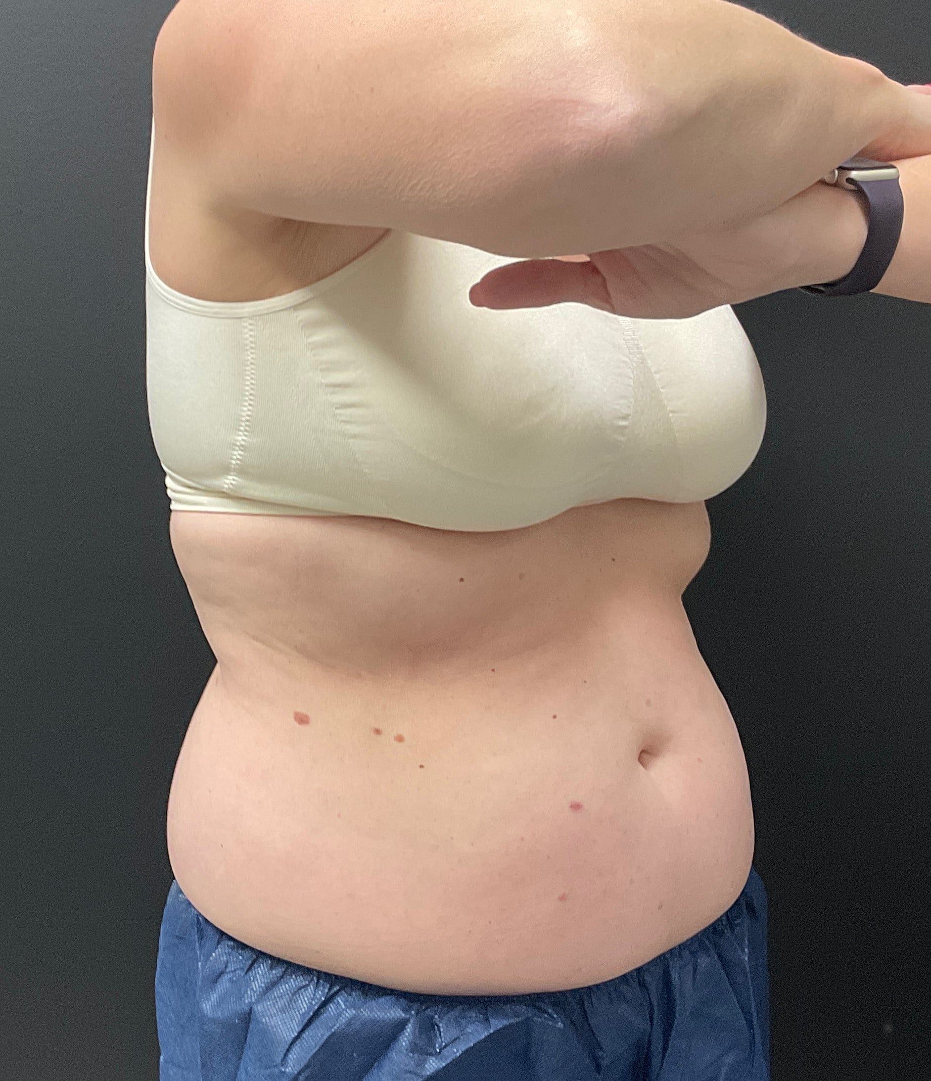 Before Image: CoolSculpting – Abdomen and Flanks - right-front-oblique