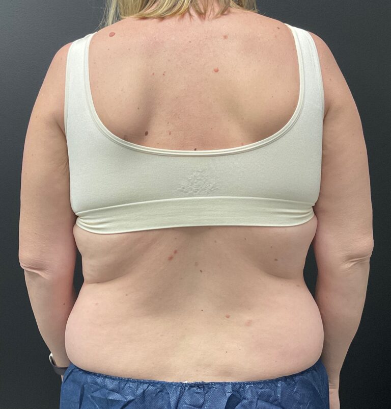 Before Image: CoolSculpting – Abdomen and Flanks - back