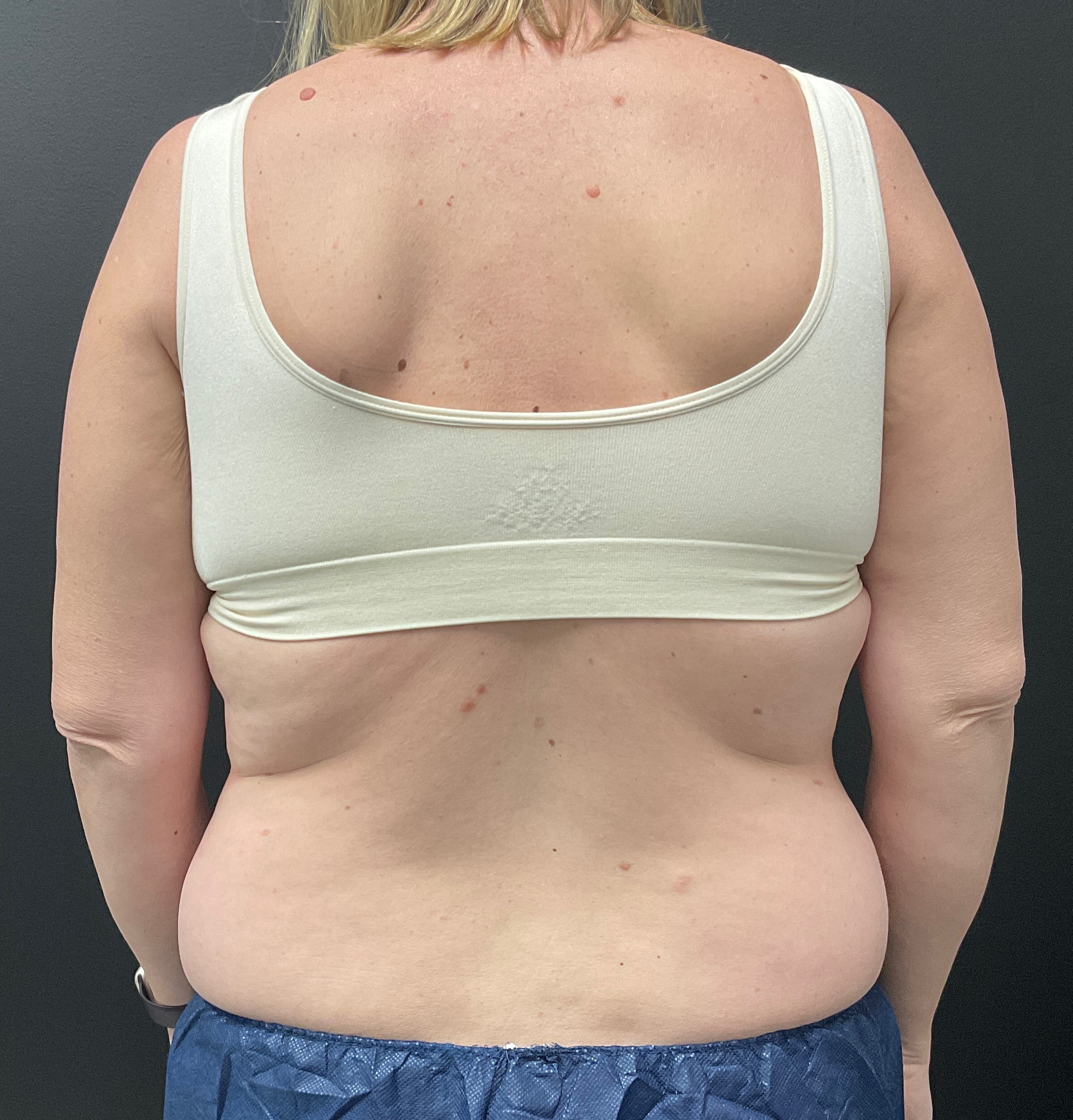 Before Image: CoolSculpting – Abdomen and Flanks - back