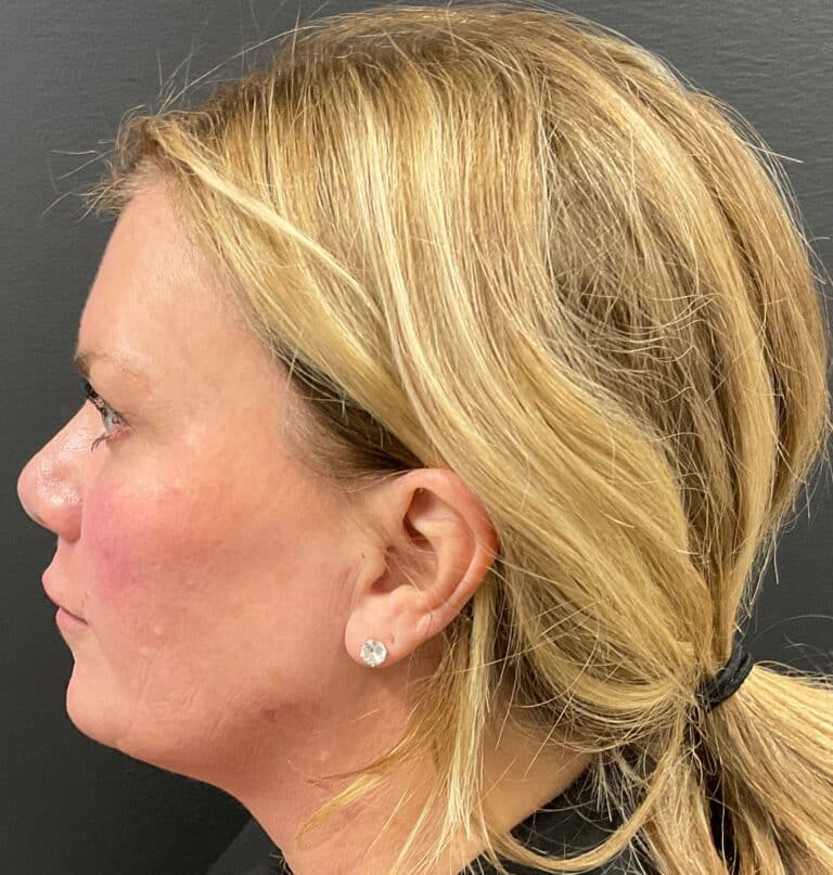 After Image: CoolSculpting, Voluma, and Volux - left-side