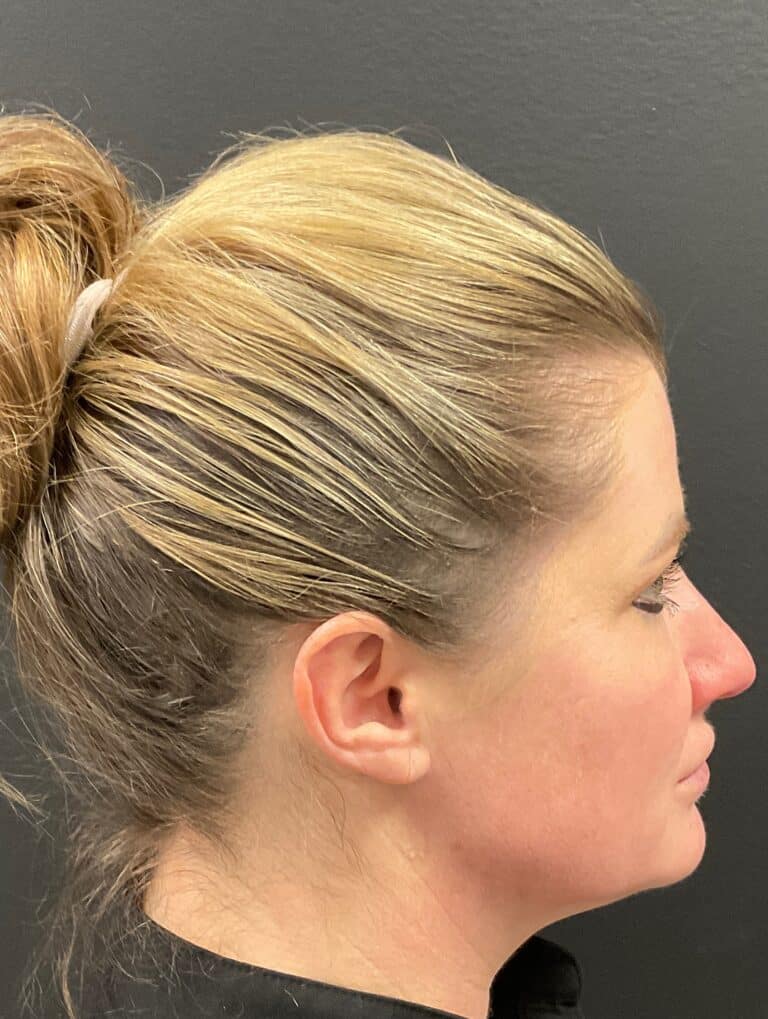 After Image: CoolSculpting, Voluma and Volux - right-side
