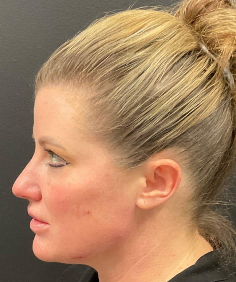 After Image: CoolSculpting, Voluma and Volux - left-side