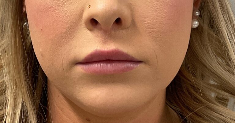 Before Image: Dermal Filler – Versa (Lips) - front
