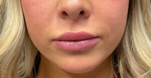 Dermal Filler – Versa (Lips)