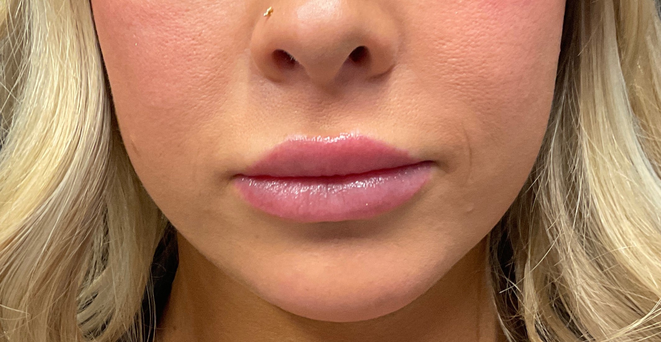 After Image: Dermal Filler – Versa (Lips) - front