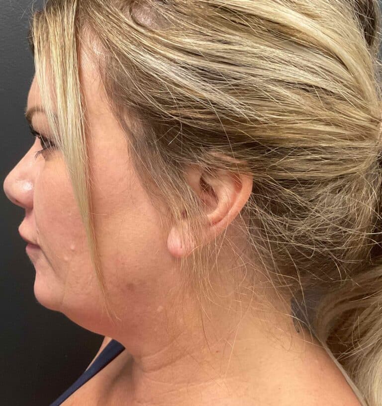 Before Image: CoolSculpting, Voluma, and Volux - left-side