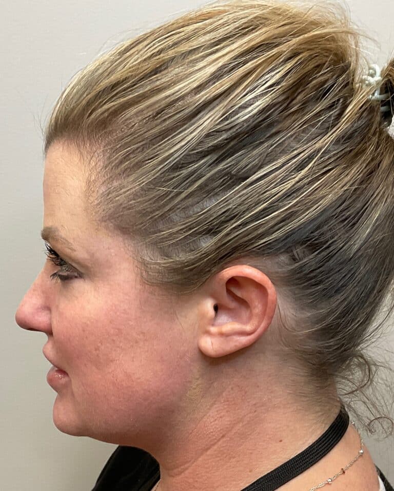 Before Image: CoolSculpting, Voluma and Volux - left-side