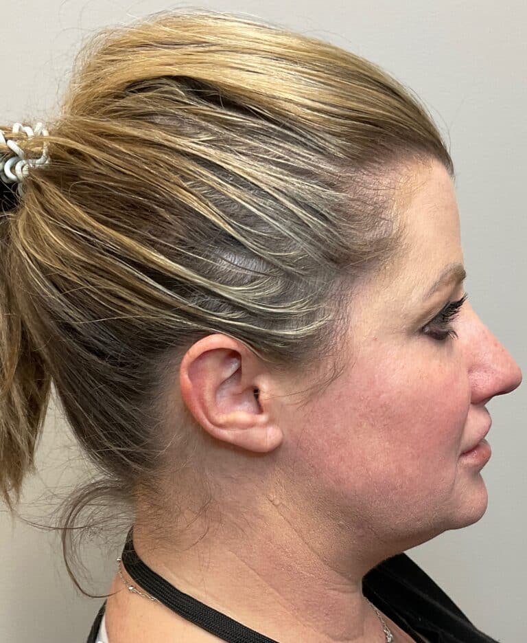 Before Image: CoolSculpting, Voluma and Volux - right-side