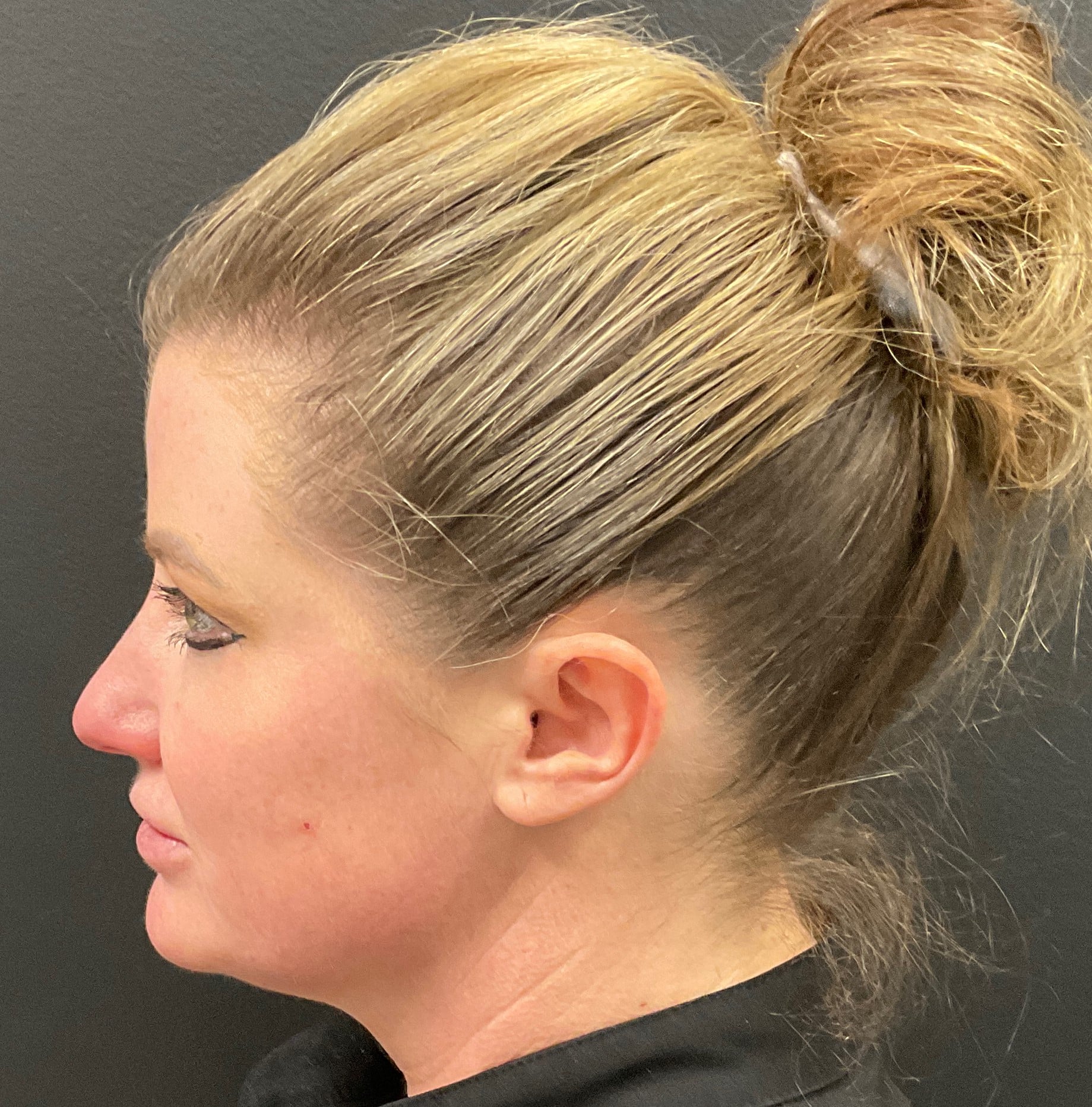 Before Image: Dermal Filler – Volux (Jaw) - left-side