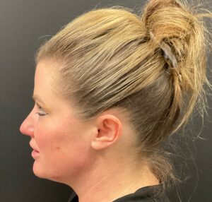 After Image: Dermal Filler – Volux (Jaw)