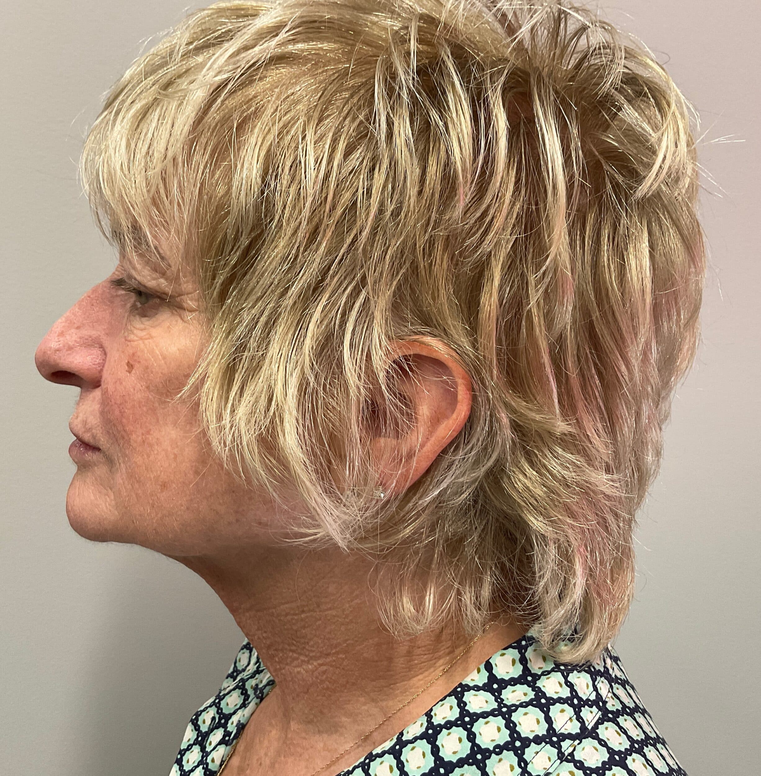 Before Image: Dermal Filler – Cheek, Chin, Jaw - left-side