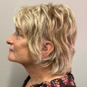 After Image: Dermal Filler – Cheek, Chin, Jaw